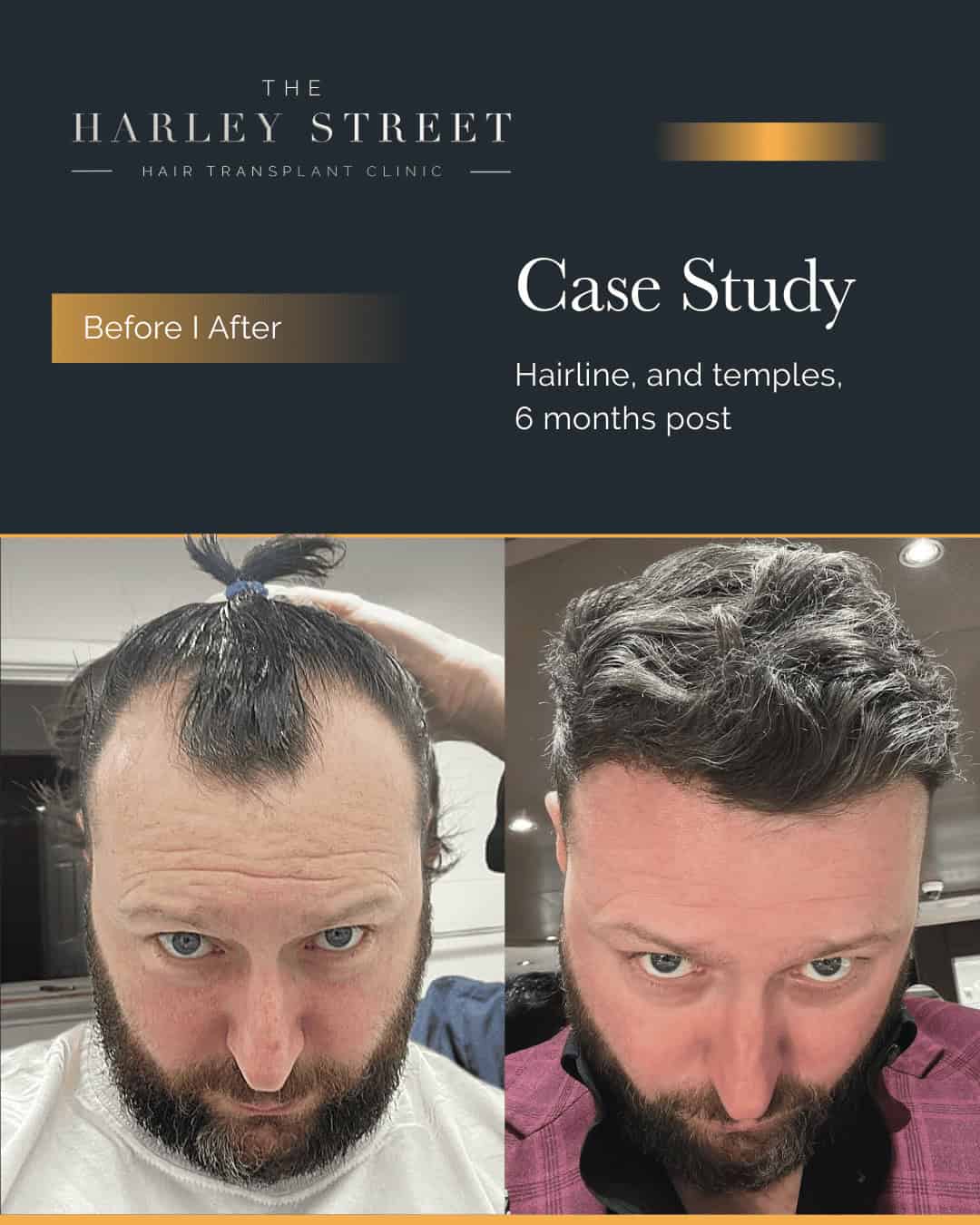 Harley Street Hair Transplant Clinics